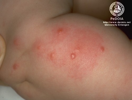 Bed Bug Bites On Genitalia For most common insect bites,