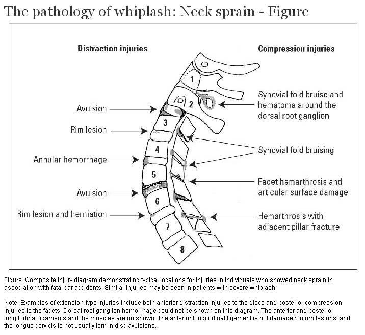 The Pathology Of Whiplash Neck Sprain British Columbia Medical