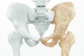 Questions in osteoporosis management